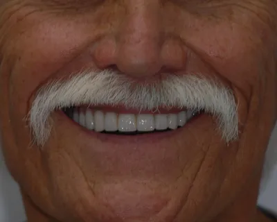 After dental implant treatment