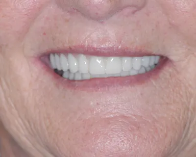 After dental implant treatment