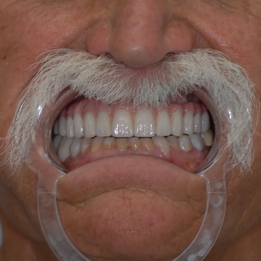 Patient smiling after All-on-4 full arch dental implant restoration
