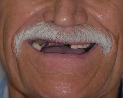 Before dental implant treatment