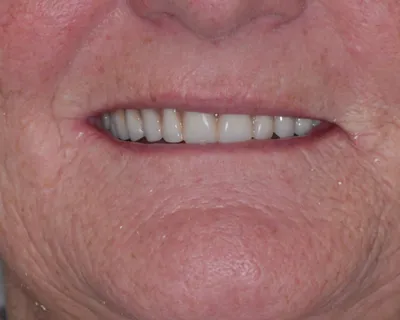 Before dental implant treatment