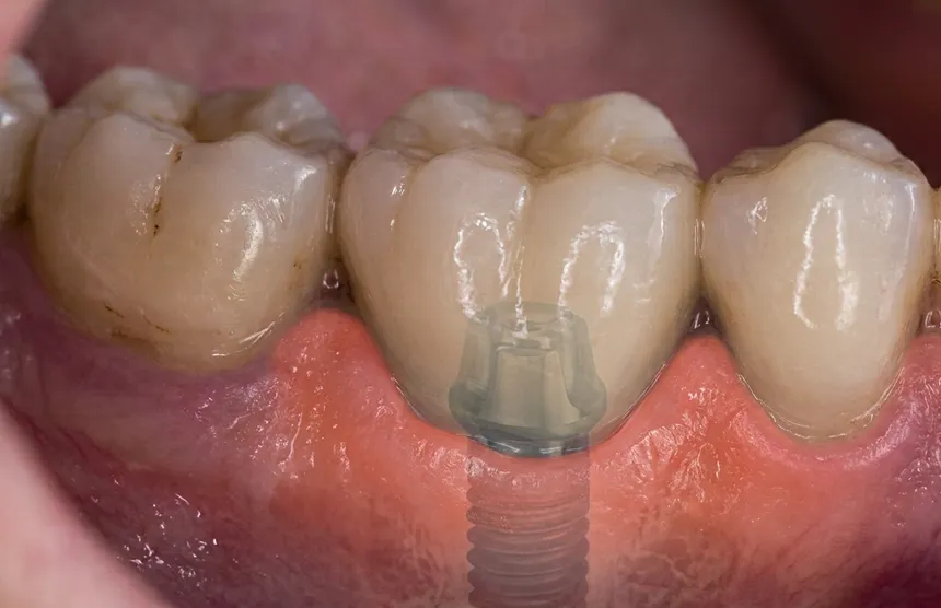 Dental implant with titanium post and natural-looking crown