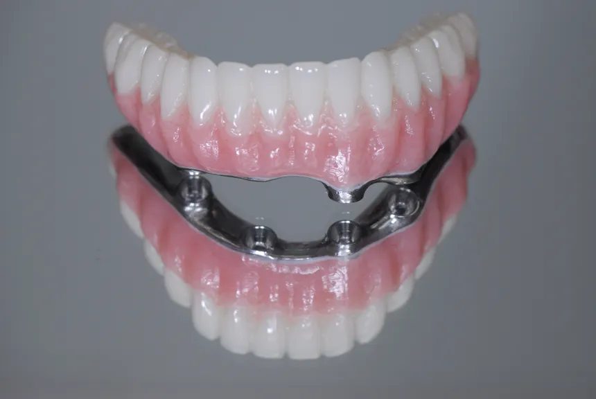 All-on-X full arch dental implant restoration