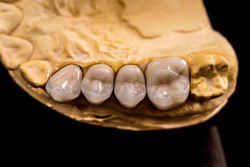 Custom dental bridge restoring a complete, natural smile